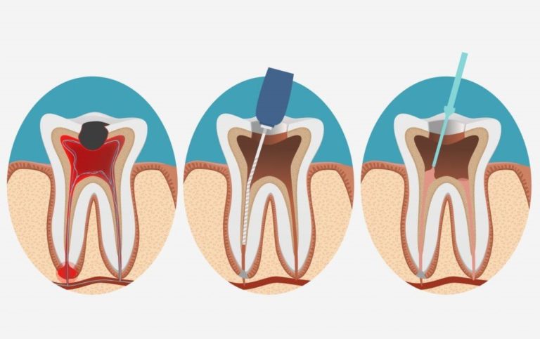 Лечение каналов зуба