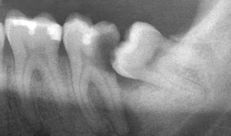 Прорезывание зуба мудрости у взрослых – затрудненное и нормально. Как снять боль при прорезывании зуба мудрости. Сколько растет зуб мудрости после прорезывания.