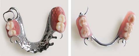 Бюгельный протез на кламмерах