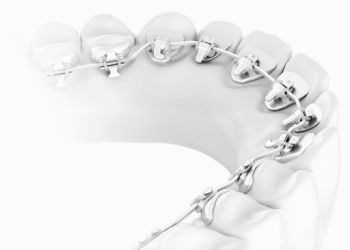 Лингвальные брекеты