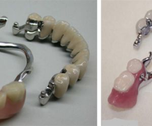 Бюгельный протез на замках