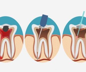 Лечение каналов зуба