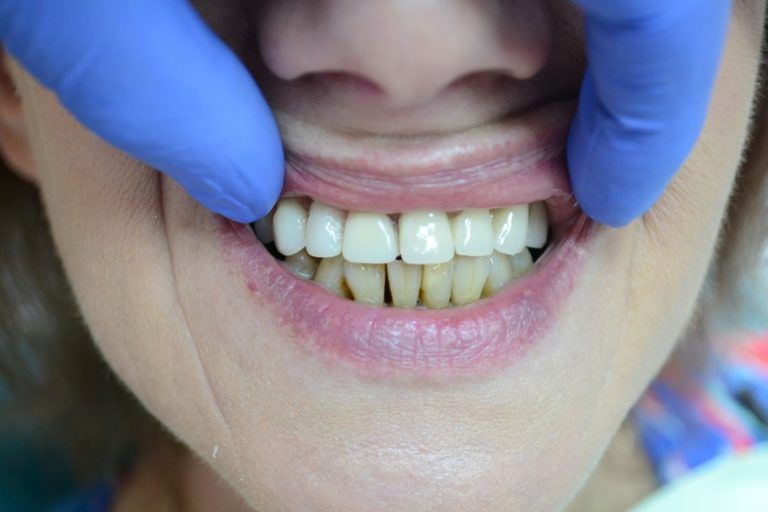 Протезирование передних зубов