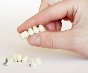 Протезирование зубов коронками