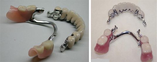 Бюгельный протез на замках