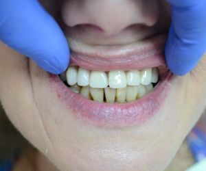 Протезирование передних зубов