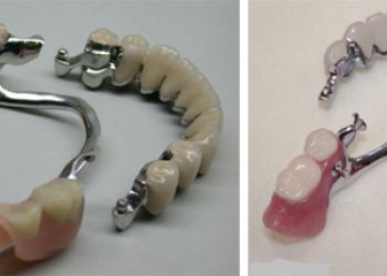 Бюгельный протез на замках