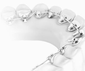 Лингвальные брекеты