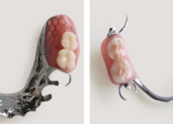 Бюгельный протез на кламмерах