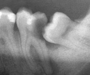Прорезывание зуба мудрости у взрослых – затрудненное и нормально. Как снять боль при прорезывании зуба мудрости. Сколько растет зуб мудрости после прорезывания.