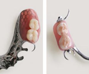 Бюгельный протез на кламмерах