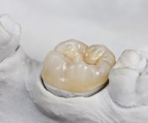 Зубные вкладки