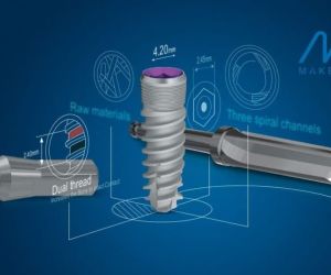 Имплантация зубов с помощью имплантатов MIS