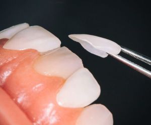 Зубные виниры