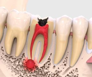 Лечение кисты зуба