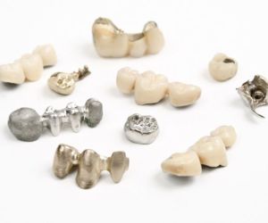 Виды зубных коронок