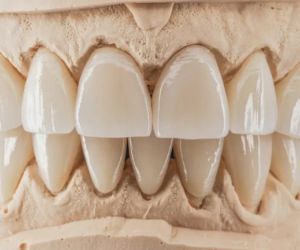 Коронки на передние зубы