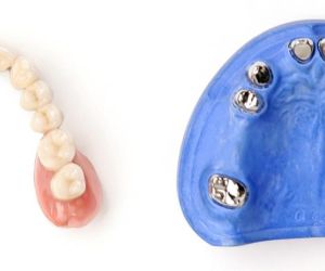 Бюгельный протез на телескопических коронках