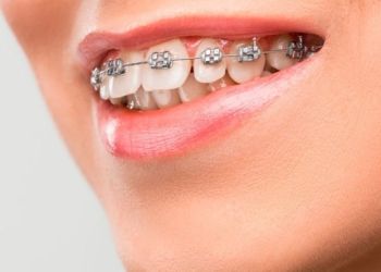 Брекеты на зубы