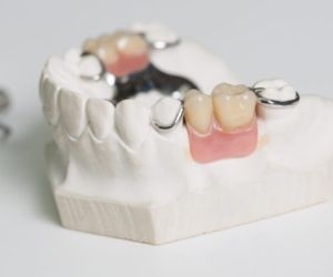 Бюгельный протез на нижнюю челюсть