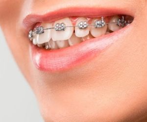 Брекеты на зубы