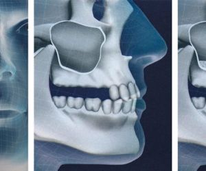 Синус -лифтинг