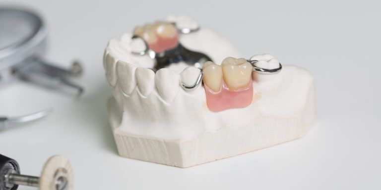 Бюгельный протез на нижнюю челюсть